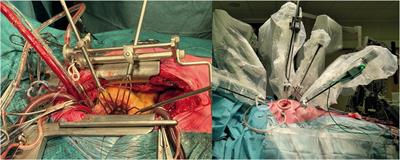Robotic mitral valve repair surgery: where do we go from here?